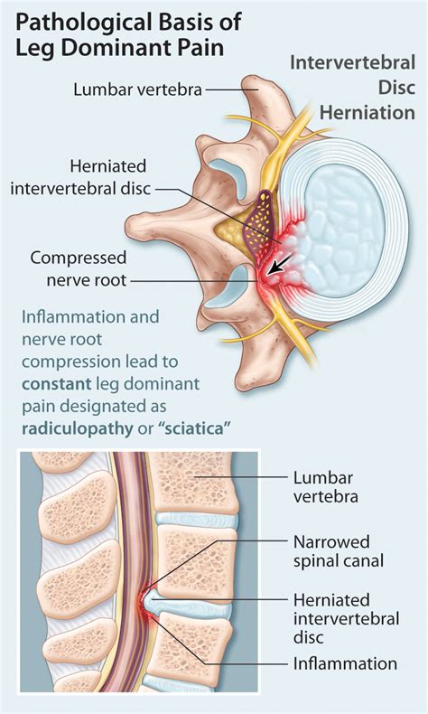 neurogenic claudication | healthPlexus.net