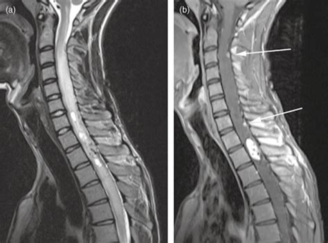 Spinal Lesions On MRI