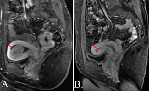 Uterine Artery Embolization - Fibroids | UCLA Health