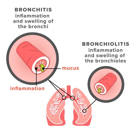 Bronchiolitis vs. Bronchitis: Symptoms, Causes, and Treatments