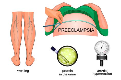 New Headache in Pregnancy: Ruling out Preeclampsia, Eclampsia, and Cer ...