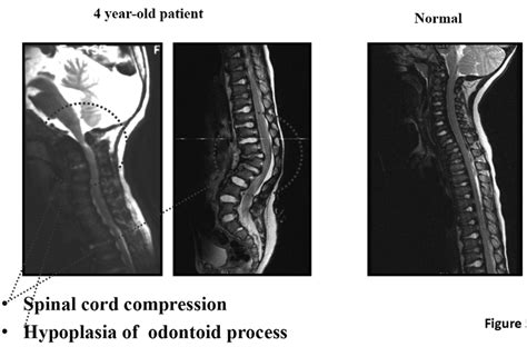 MRI of cervical spine in a patient aged 4 years (Copyright permission... | Download Scientific ...