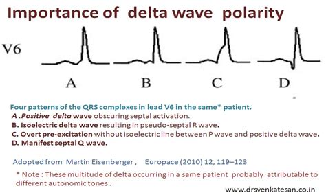 Delta wave blues in WPW syndrome : What is the relationship between delta wave and qrs complex ...