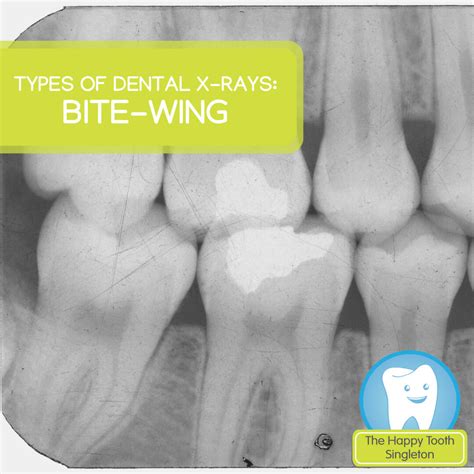 Types of dental x-rays: Bite-wing | The Happy Tooth Singleton