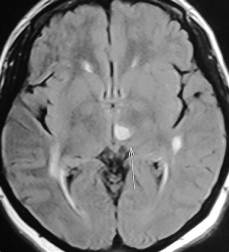 FLAIR Image of left thalamic infarct | Download Scientific Diagram