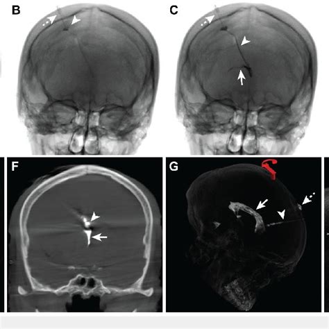 Head computed tomography images before and after Ommaya reservoir ...