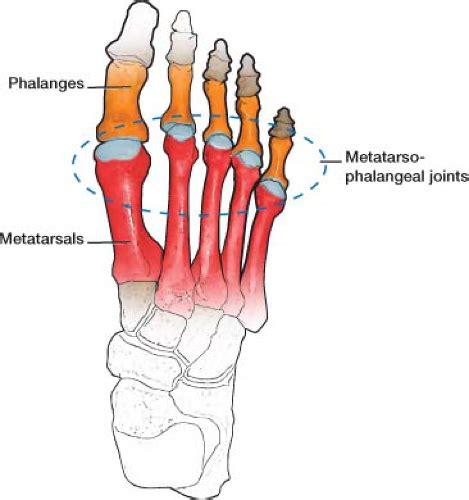 Arthritis and Other Abnormalities of the Metatarsophalangeal and Interphalangeal Joints ...