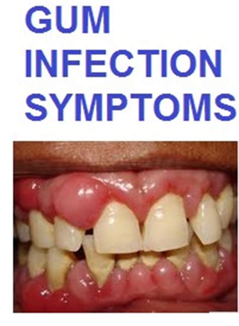 gum infection symptoms pictures Archives - Natural Health Advocates