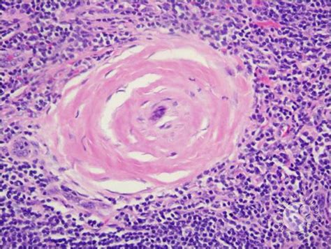 Castleman disease - 4.