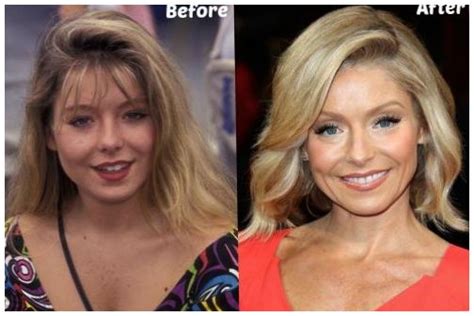 Megyn Kelly facelift before and after photos ~ Celebrity Plastic Surgery News | Before and After ...