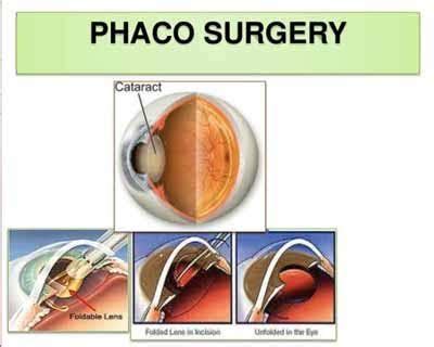 Government mulling conducting all eye operations through phaco surgery ...