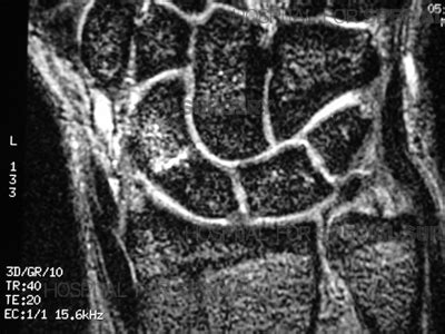 Scaphoid Fractures and Non-Union: Wrist Fractures and Treatment - HSS.edu