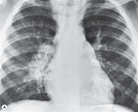 Radiology Pearls: TUBERCULOSIS