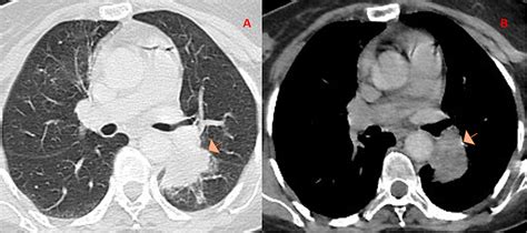 Hemiballismus Secondary to Metastatic Lung Cancer: A Case Report | Cureus