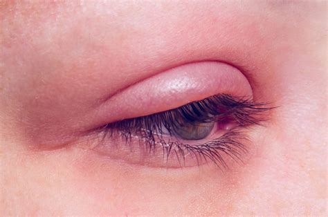 Posterior & Anterior Blepharitis (Eyelid Inflammation)