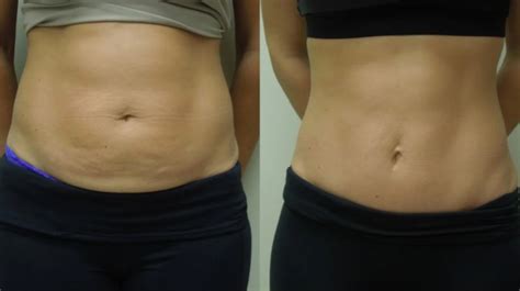 Gained 20 pounds after tummy tuck - Cosmetic Surgery Tips