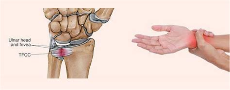 TRIANGULAR FIBROCARTILAGE COMPLEX INJURY (TFCC) - MOTUS Physical Therapy