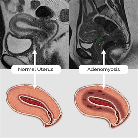 Adenomyosis images - Fibroid Treatment Clinic