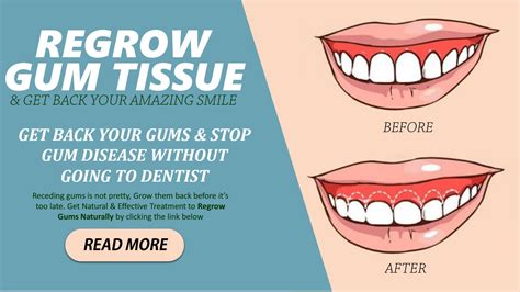 Regrow Gum Tissue Naturally by DawnGrove - Issuu