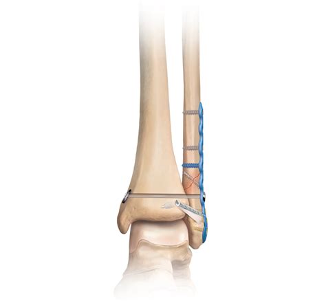 Arthrex - Internal Fixation of Ankle Fractures