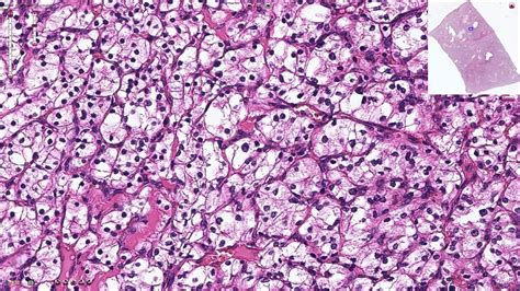 Clear Cell Renal Cell Carcinoma - Histopathology - YouTube