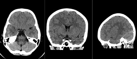 Radiology MRI: Herpes Simplex Encephalitis