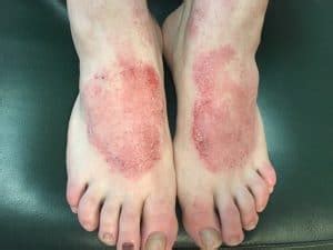 Eczema Treatments Eczema Causes - Beaver Valley Foot Clinic