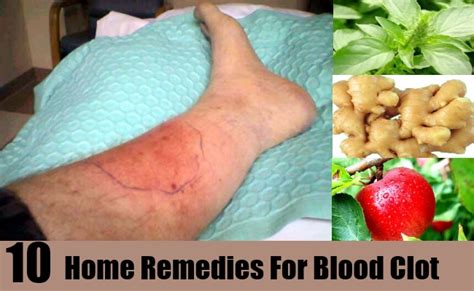 10 Home Remedies For Blood Clots – Natural Home Remedies & Supplements