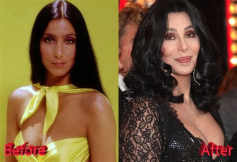 Cher Plastic Surgery : Just Too Much Of Procedures