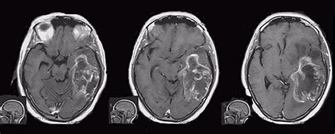 Transtentorial Herniation Axial