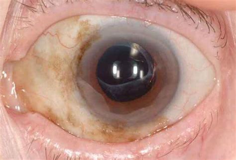 Conjunctival Primary Acquired Melanosis | Wills Eye Hospital