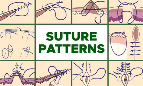 Common Suture Patterns and Suture Techniques – EndoGynecology