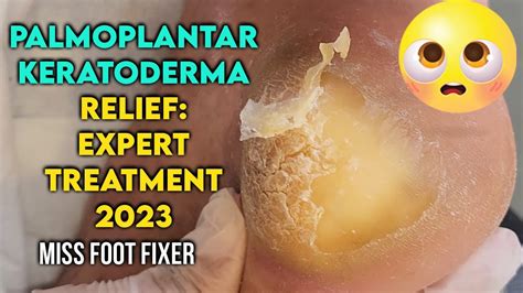 Palmoplantar Keratoderma Relief: Expert Treatment for Thick Callus ...