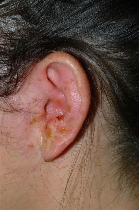 An itchy ear that became painful | The BMJ