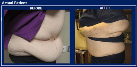 Panniculectomy Reno - Excess Skin Removal - Nevada Surgical