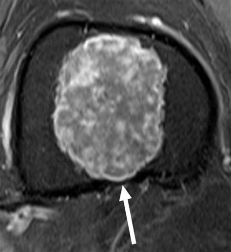 Enchondorma or Chondrosarcoma: not so easy! - European Radiology