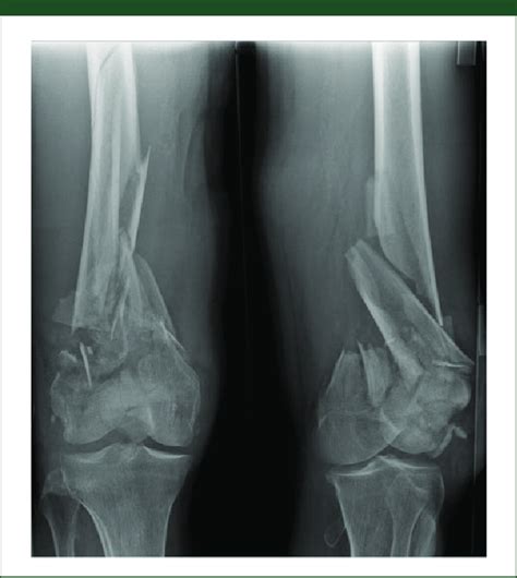 Bilateral distal femur fractures. | Download Scientific Diagram