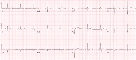 Wellens' syndrome, reperfusion and reocclusion MI | ECG Cases | EM Cases