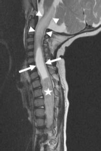 PEDIATRIC SPINAL CORD TUMORS / SPINAL CORD TUMORS IN CHILDREN