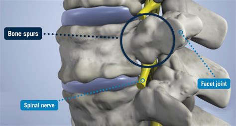 Bone Spurs - USA Spine Care - Laser Spine Surgery