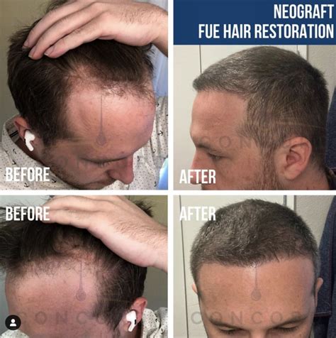 The best hair restoration - Concord Hair Restoration