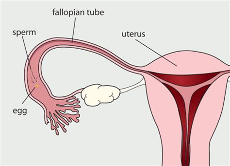 Treating tubal factor infertility in Los Angeles