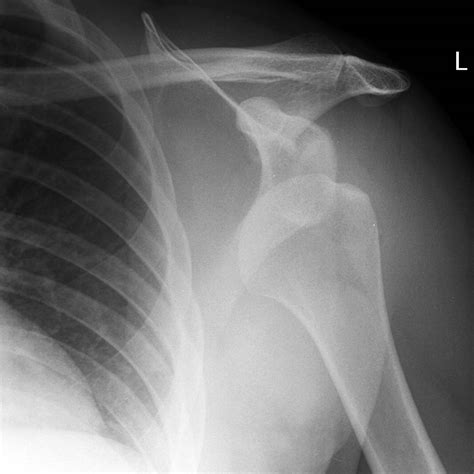 Anterior shoulder dislocation | Image | Radiopaedia.org