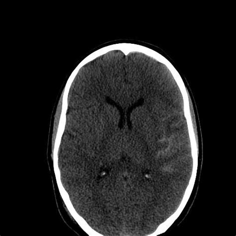 Post Gad: Trauma - Petrous Bone Fracture