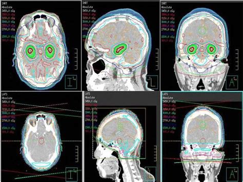 Tailored Radiation for Brain Metastases Reduces Cognitive Impact - NCI