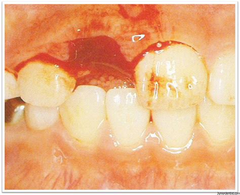 Tooth Avulsion - Exarticulation of Tooth | Treatment and Management