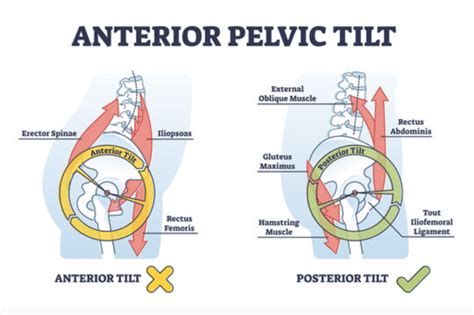 Anterior vs Posterior Pelvic Tilt: Difference, Causes & Symptoms (2022)