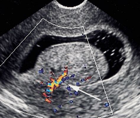 Endometrial