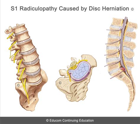 Unit 1 - S1 Radiculopathy Caused by Disc Herniation@LIFEWEST-B-U1-10-21 ...