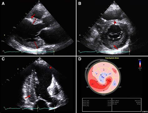 Restrictive Cardiomyopathy | Circulation Research